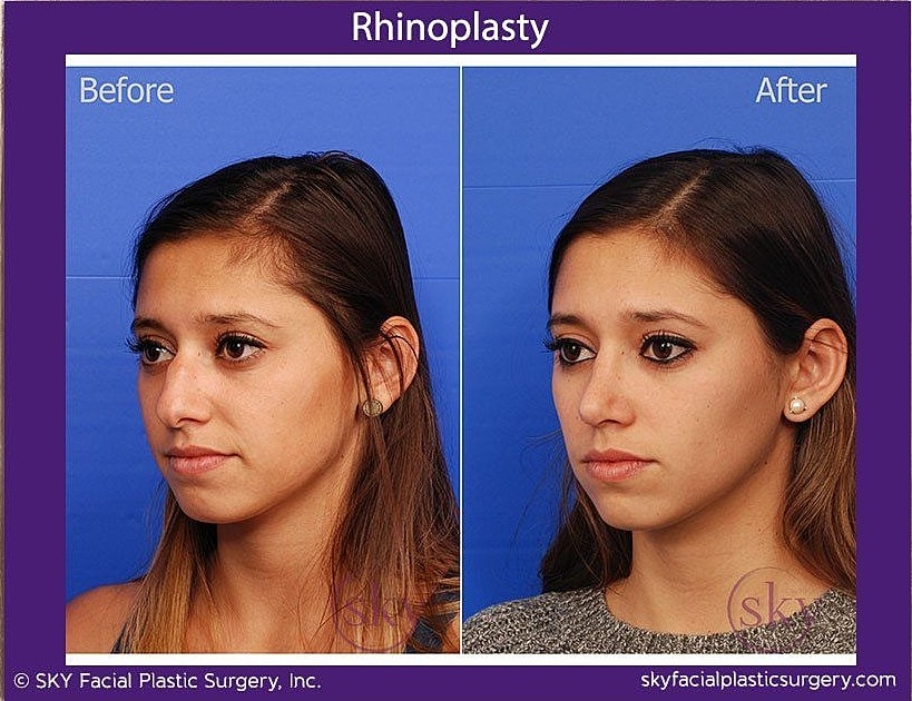 Rhinoplasty Before & After