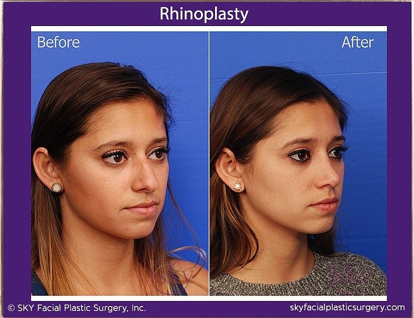 Rhinoplasty Before & After