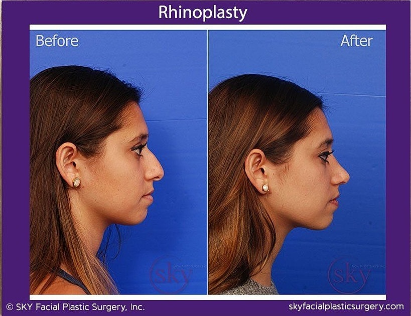 Rhinoplasty Before & After