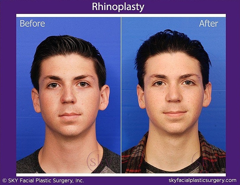 Rhinoplasty Before & After