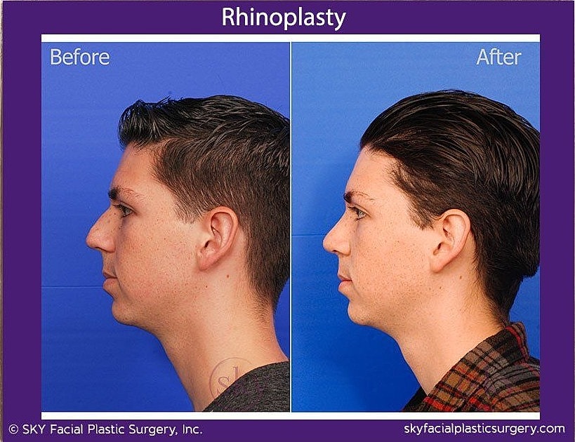 Rhinoplasty Before & After
