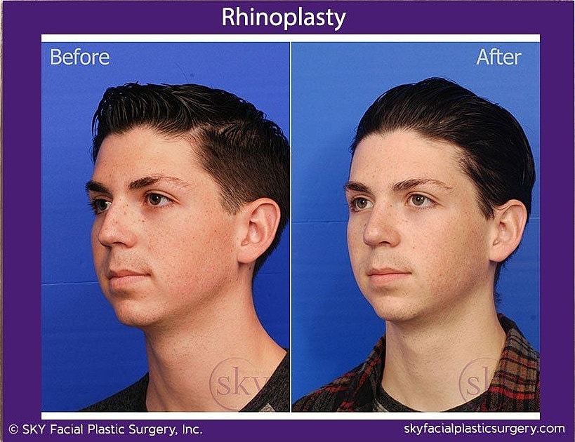 Rhinoplasty Before & After