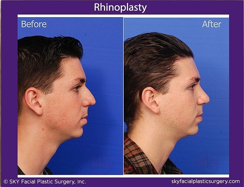 Rhinoplasty Before & After