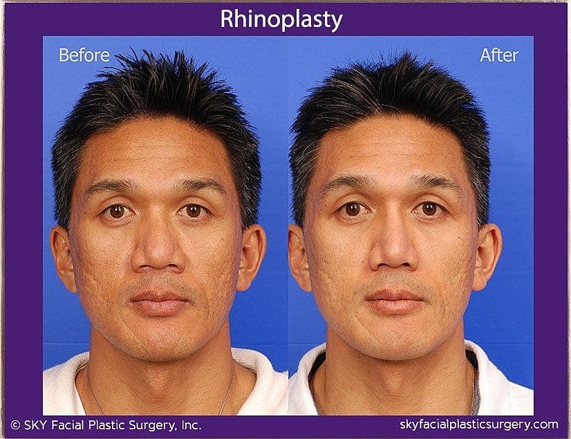 Rhinoplasty Before & After