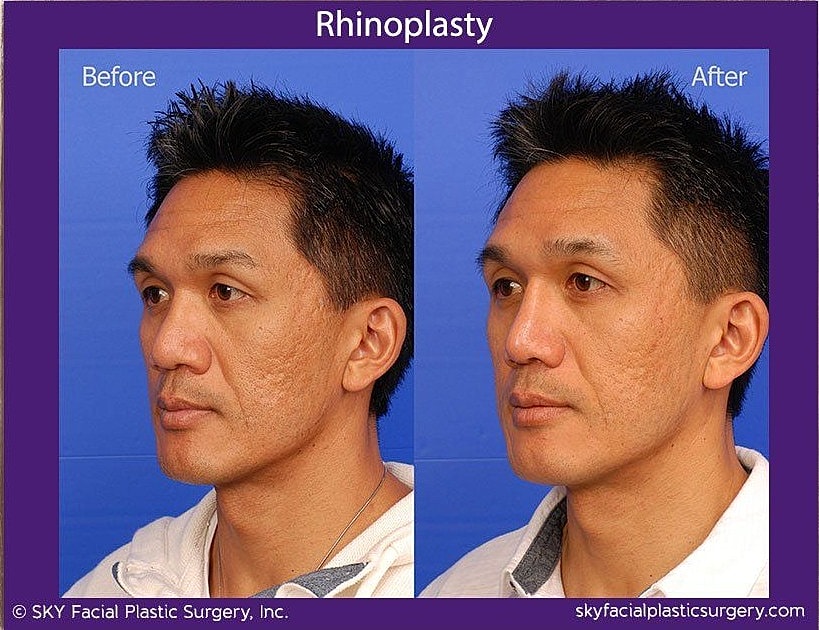 Rhinoplasty Before & After