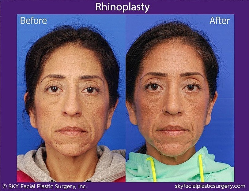 Rhinoplasty Before & After