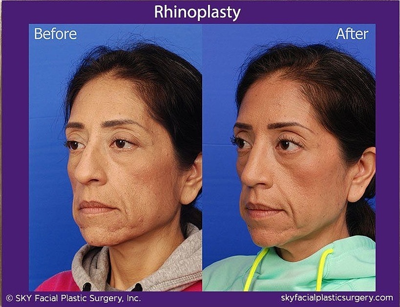 Rhinoplasty Before & After
