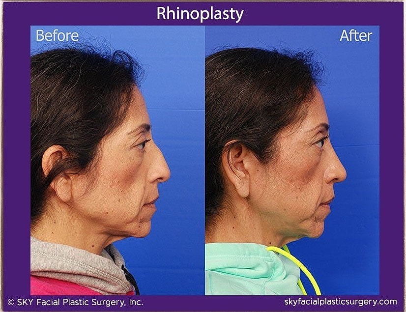 Rhinoplasty Before & After