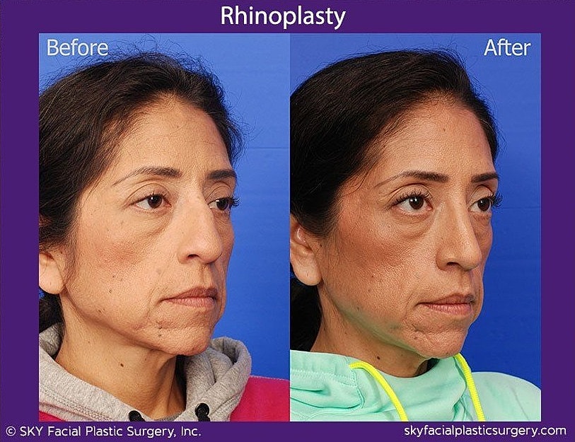 Rhinoplasty Before & After