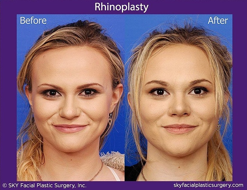Rhinoplasty Before & After