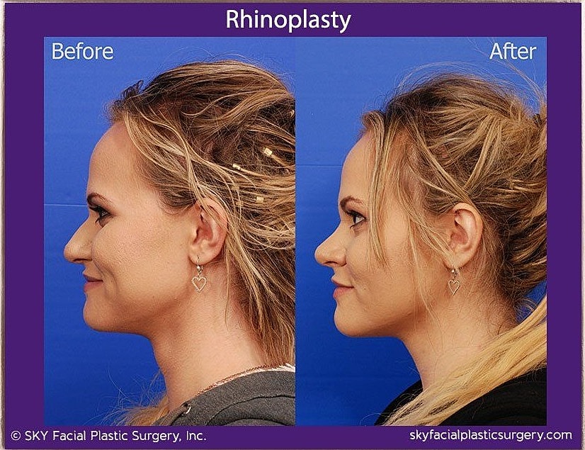 Rhinoplasty Before & After