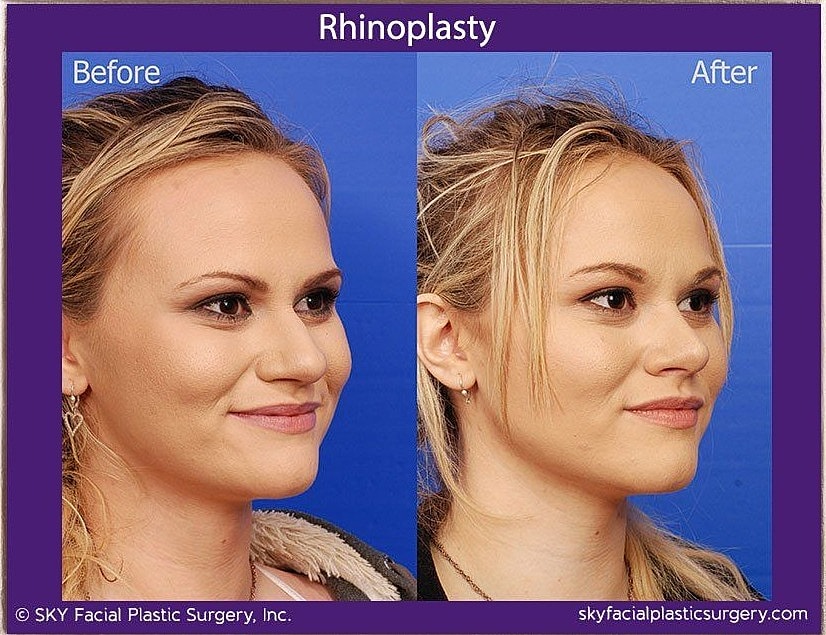 Rhinoplasty Before & After
