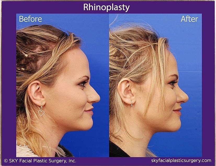 Rhinoplasty Before & After