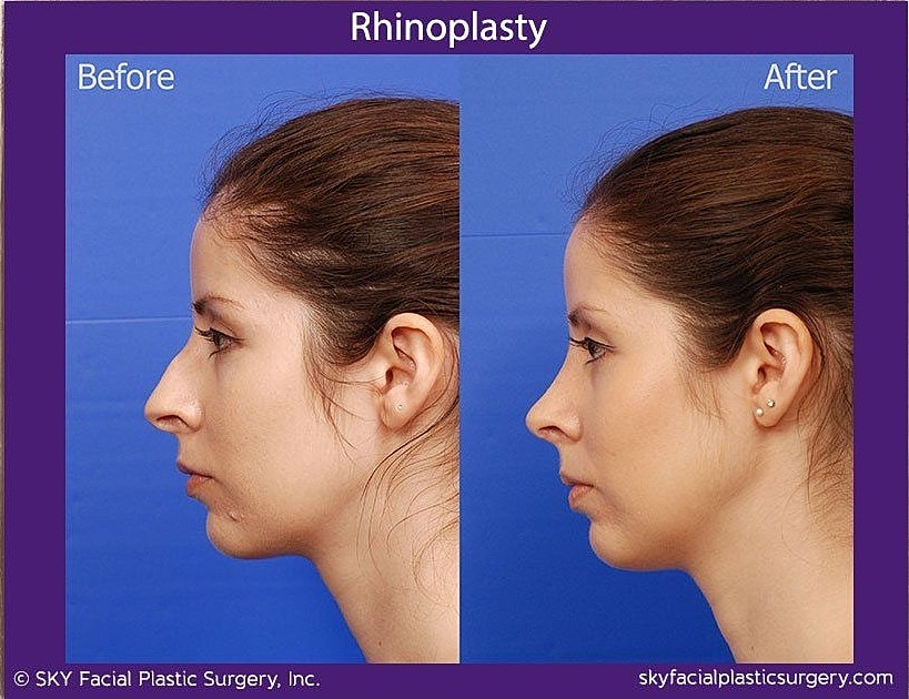 Rhinoplasty Before & After