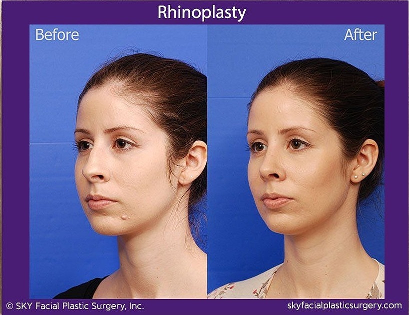 Rhinoplasty Before & After