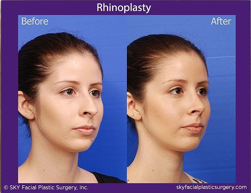 Rhinoplasty Before & After
