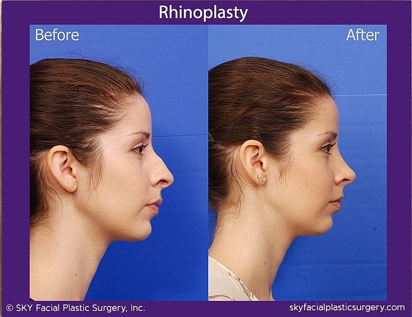 Rhinoplasty Before & After