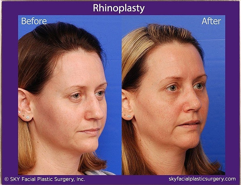 Rhinoplasty Before & After