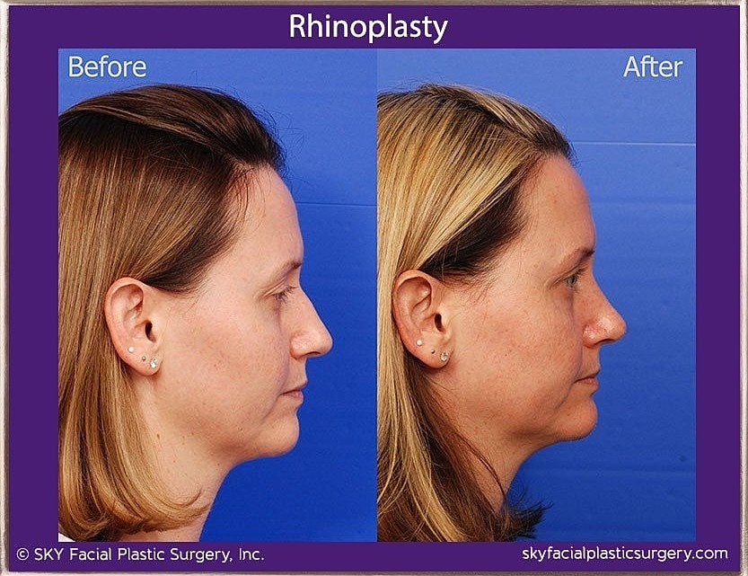 Rhinoplasty Before & After