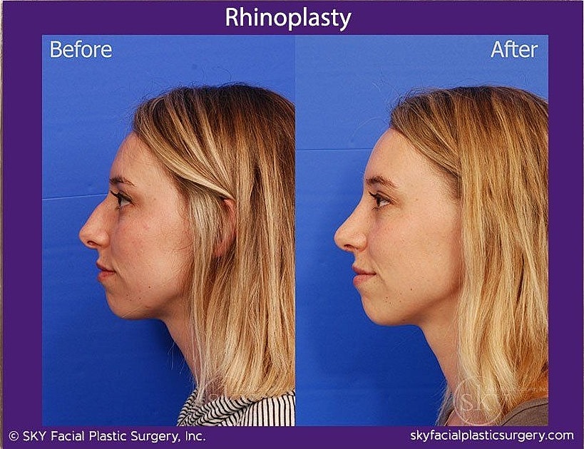 Rhinoplasty Before & After
