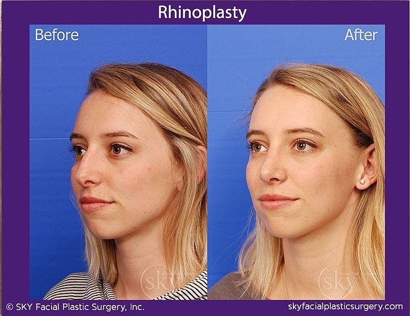 Rhinoplasty Before & After