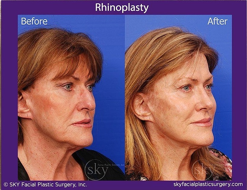 Rhinoplasty Before & After