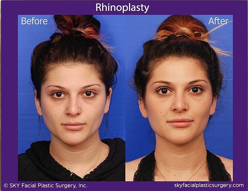 Rhinoplasty Before & After