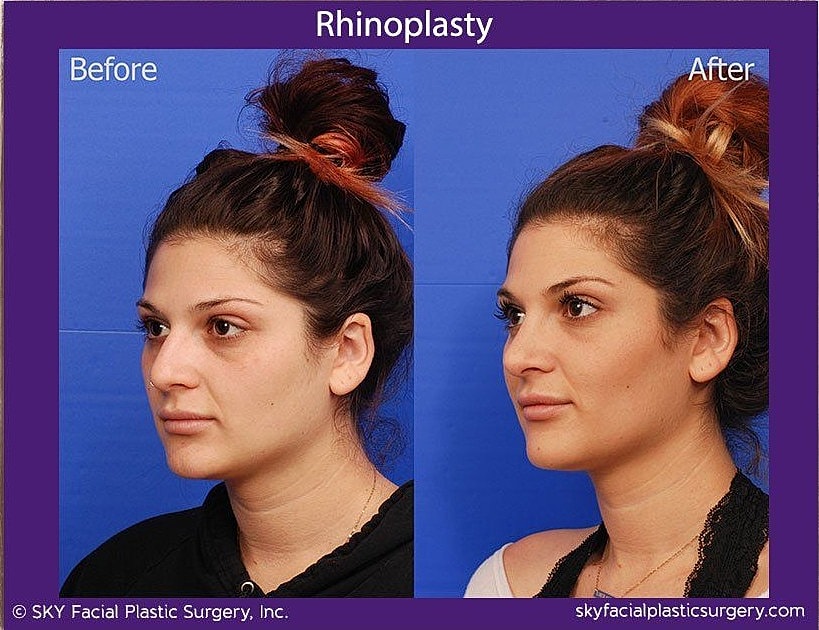 Rhinoplasty Before & After