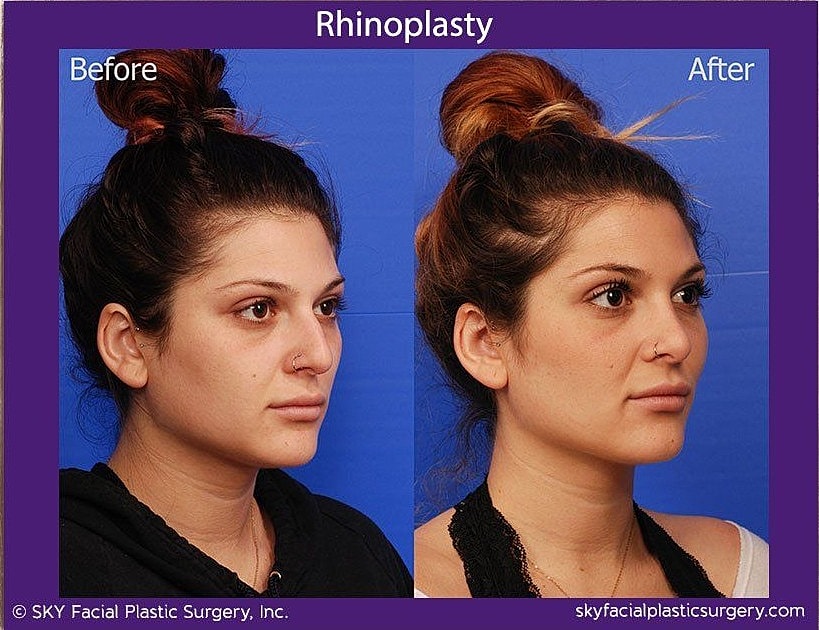Rhinoplasty Before & After