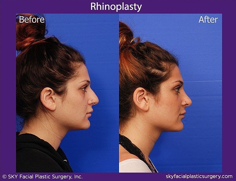 Rhinoplasty Before & After