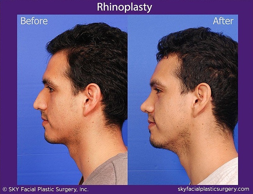 Rhinoplasty Before & After