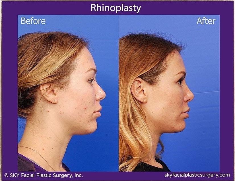 Rhinoplasty Before & After