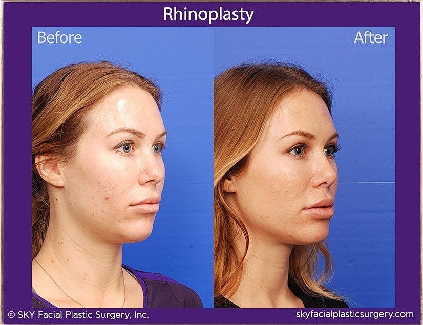 Rhinoplasty Before & After