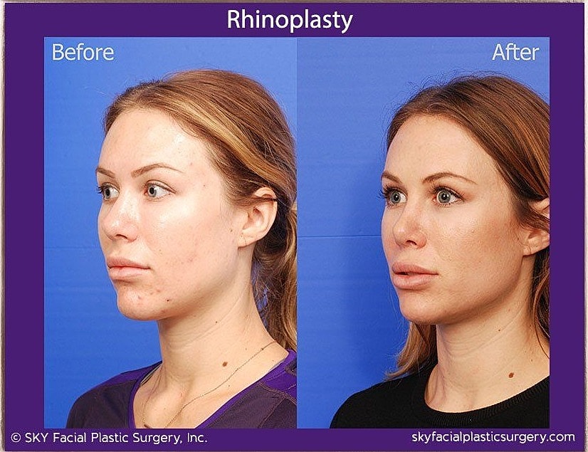 Rhinoplasty Before & After