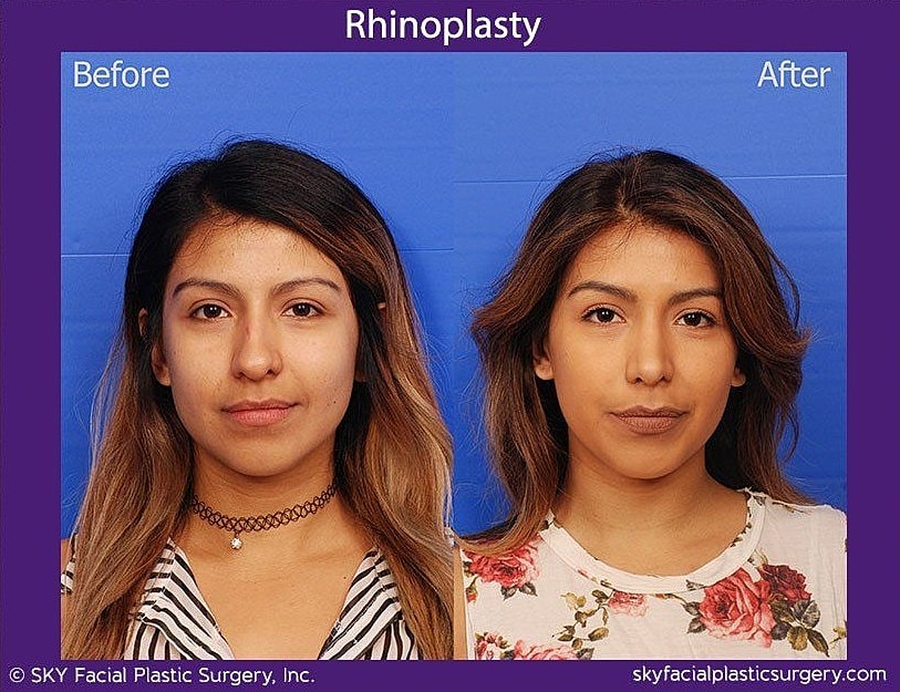 Rhinoplasty Before & After