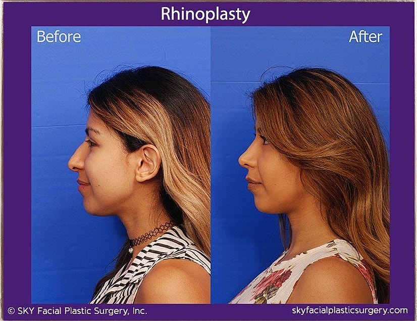 Rhinoplasty Before & After