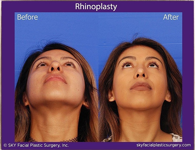Rhinoplasty Before & After