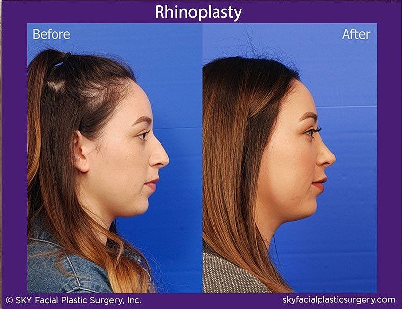 Rhinoplasty Before & After
