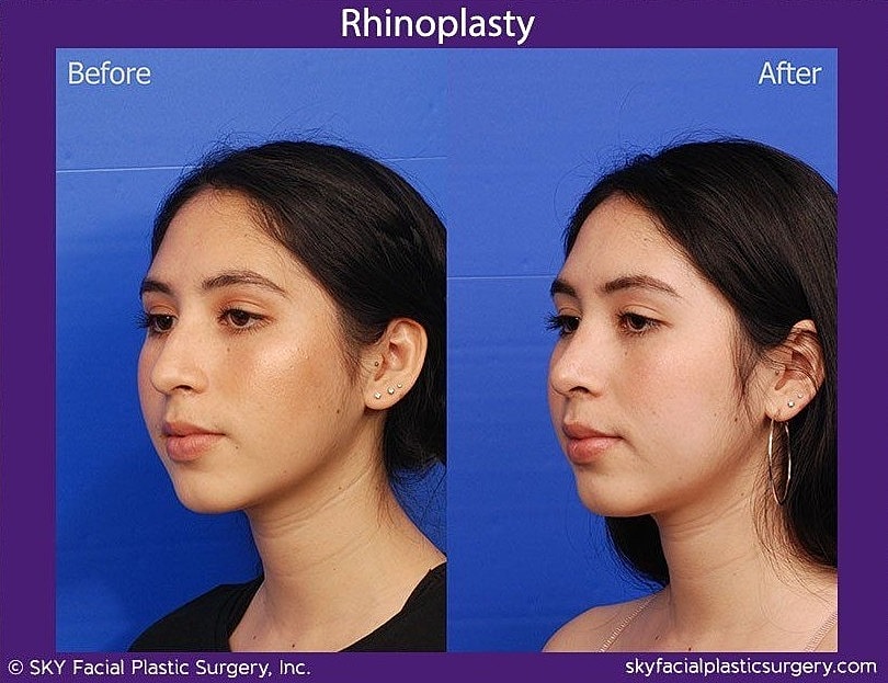 Rhinoplasty Before & After
