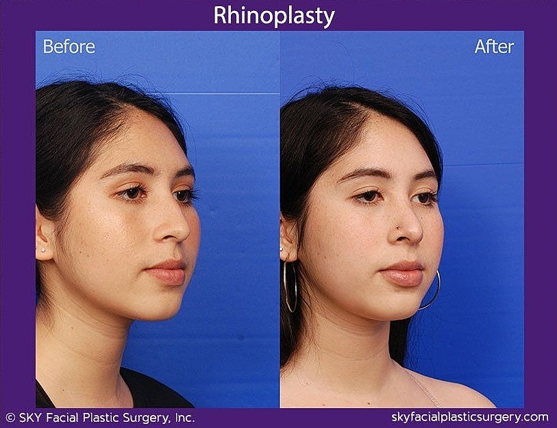 Rhinoplasty Before & After