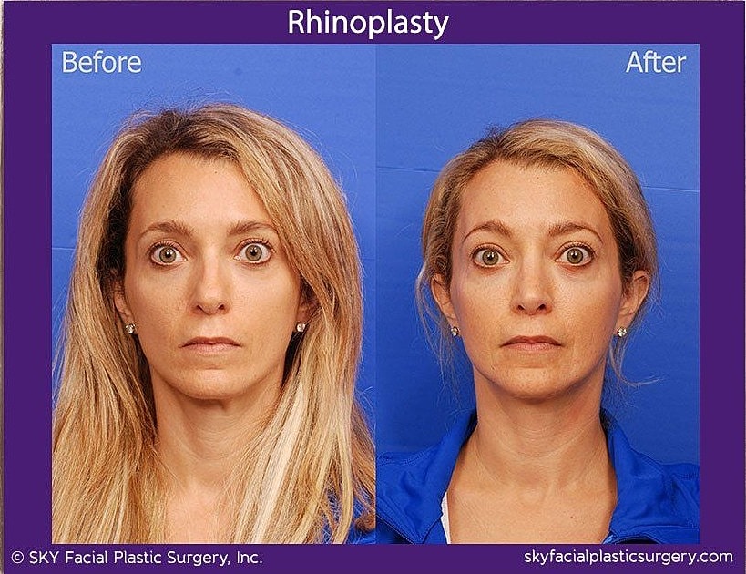 Rhinoplasty Before & After