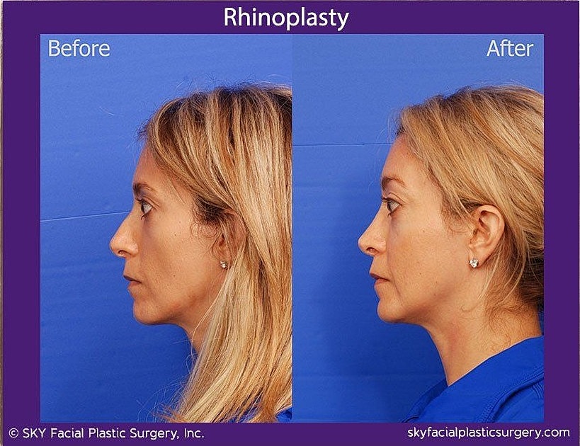 Rhinoplasty Before & After