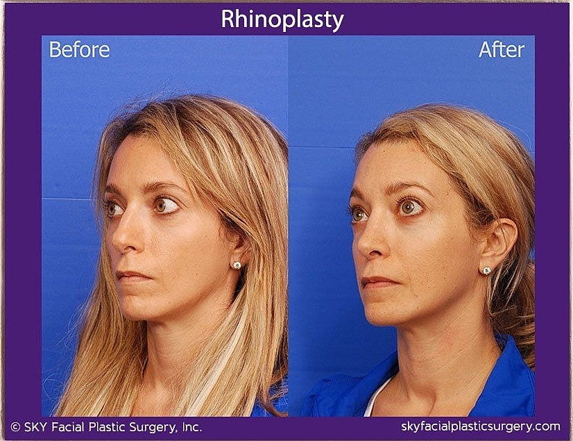 Rhinoplasty Before & After