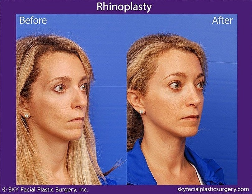 Rhinoplasty Before & After
