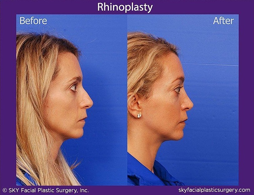 Rhinoplasty Before & After