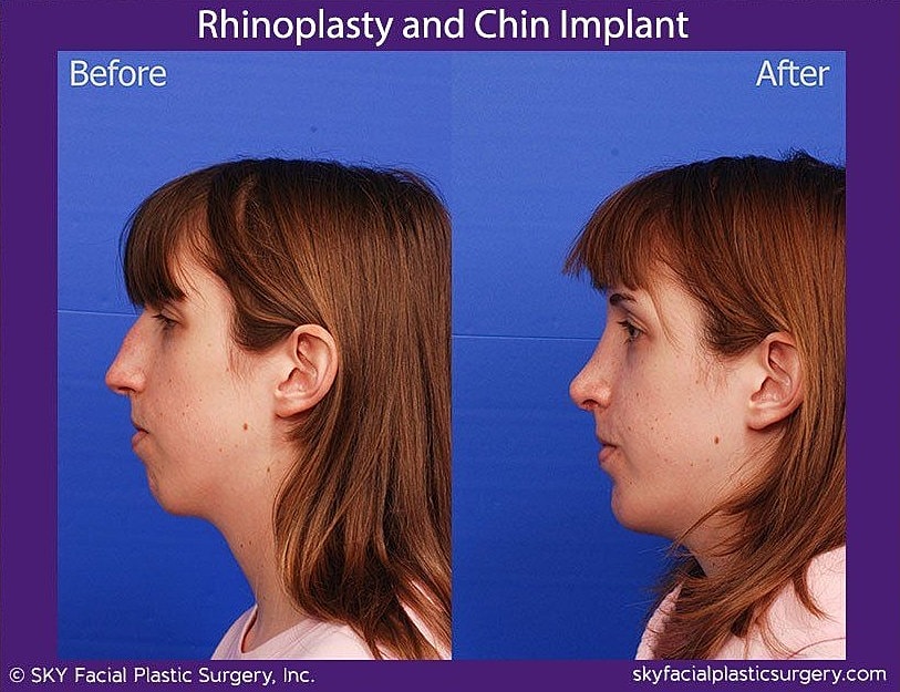 Rhinoplasty Before & After