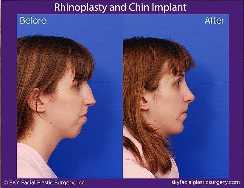 Rhinoplasty Before & After