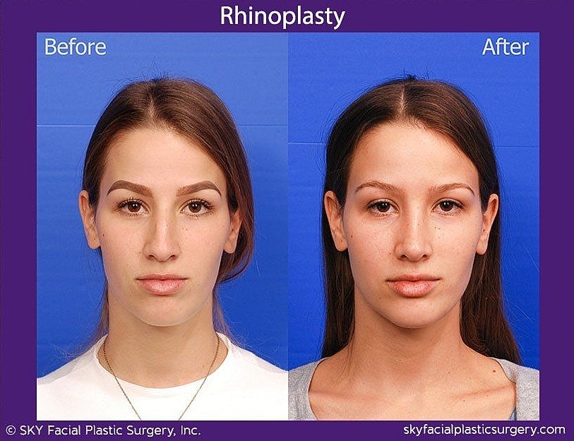Rhinoplasty Before & After