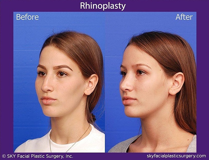 Rhinoplasty Before & After