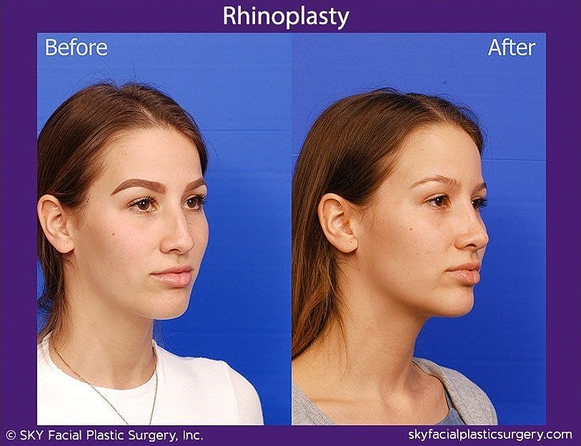 Rhinoplasty Before & After